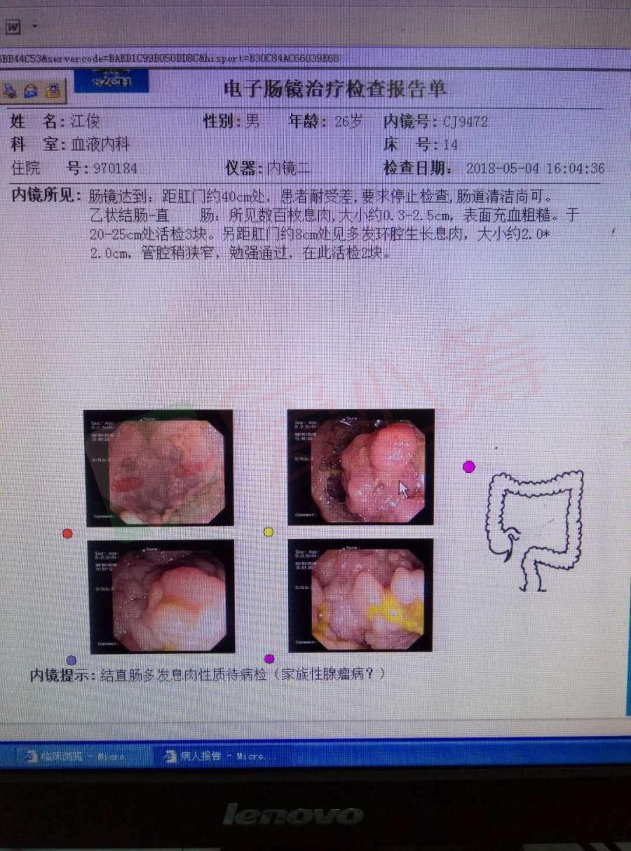 发现直肠息肉呈网状行,取出活检两块化验,确诊为家族性息肉病,后转到